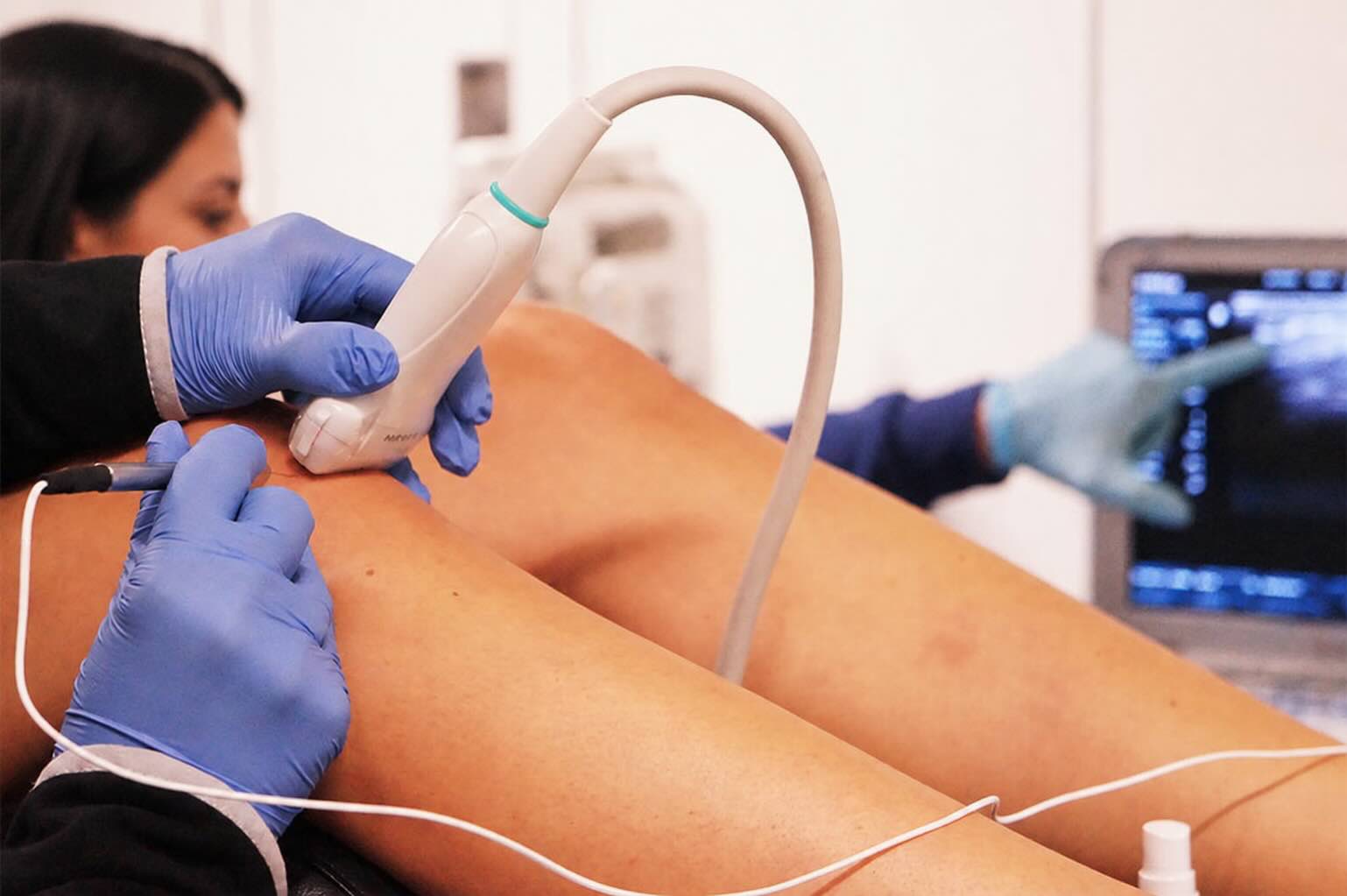 AltPoint Percutaneous Needle Electrolysis